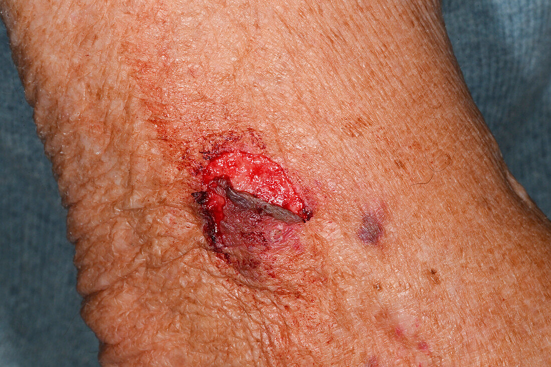 Flap laceration on a man's leg