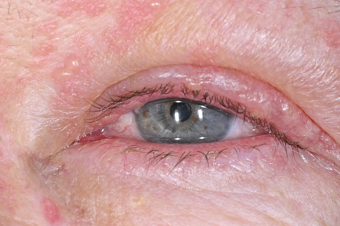 Shingles rash affecting a man's facial nerve
