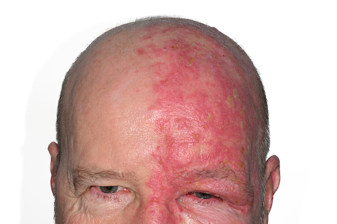 Shingles rash affecting a man's face