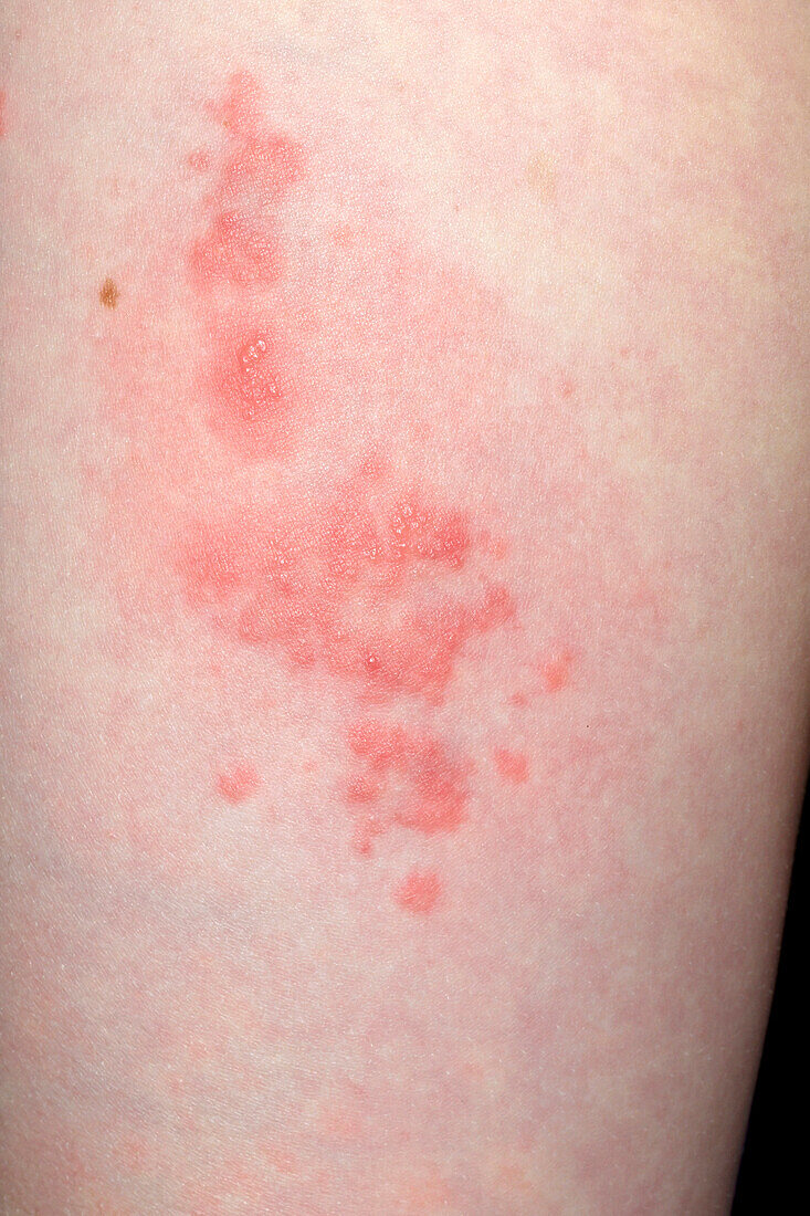 Shingles rash on a girls' thigh