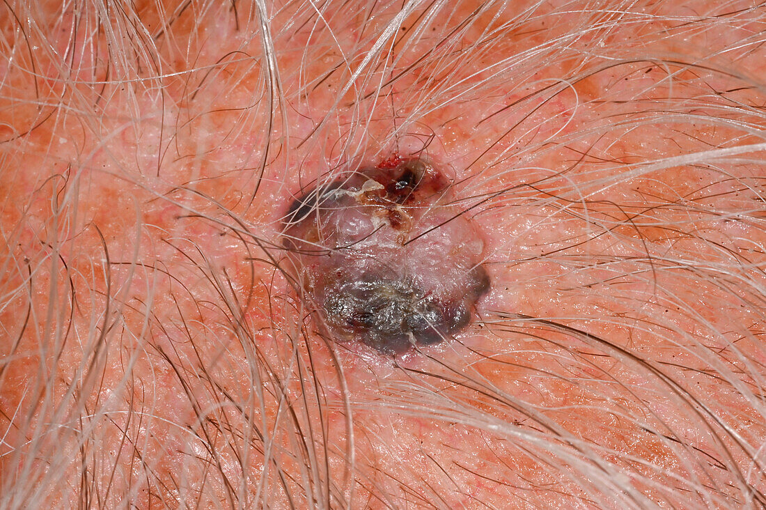 Basal cell carcinoma on a man's scalp