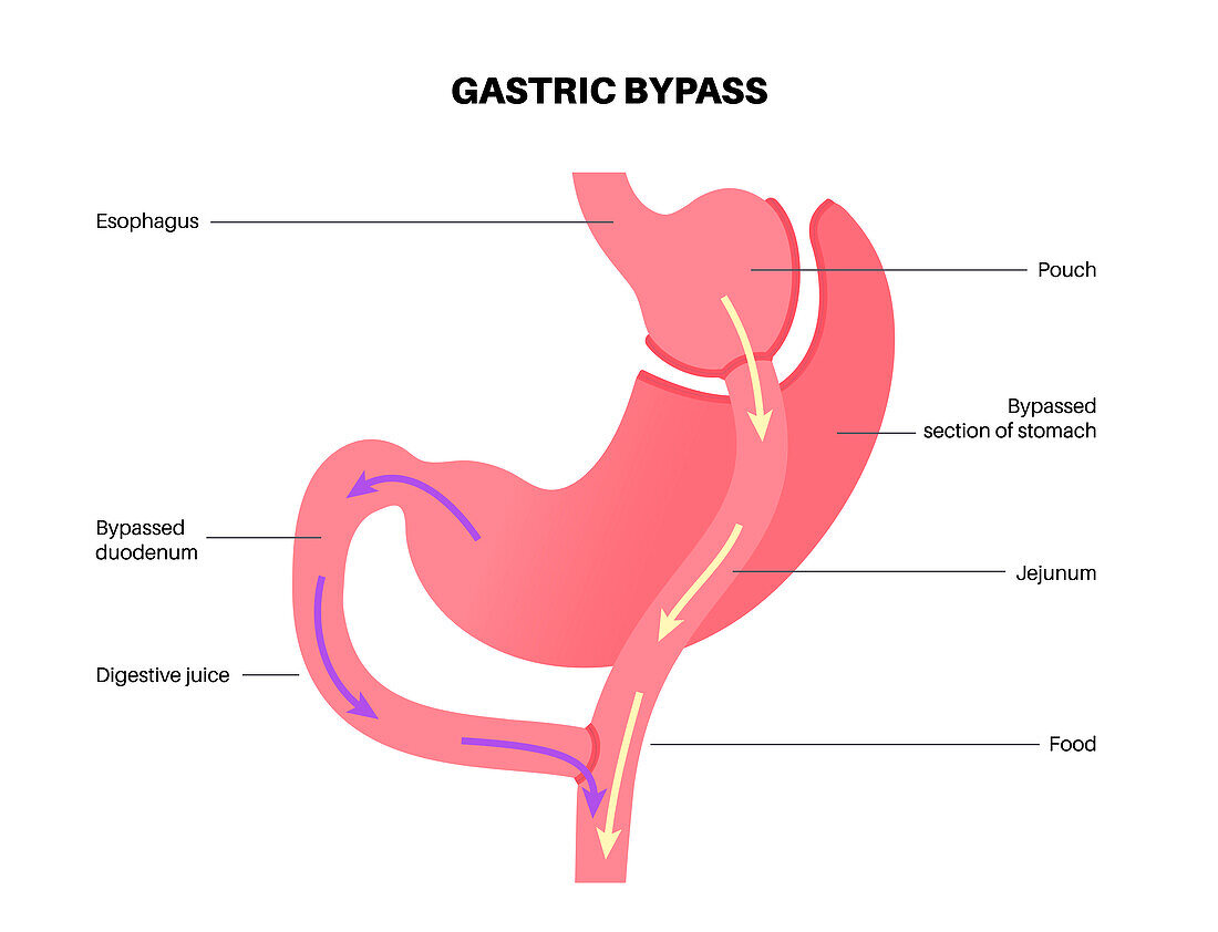 Gastric bypass surgery, illustration