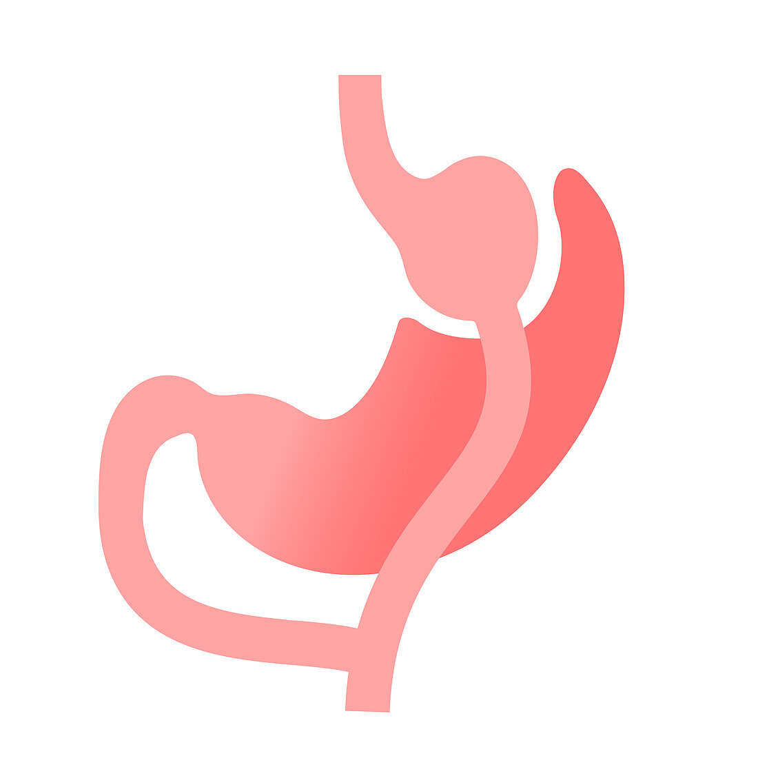 Gastric bypass surgery, illustration