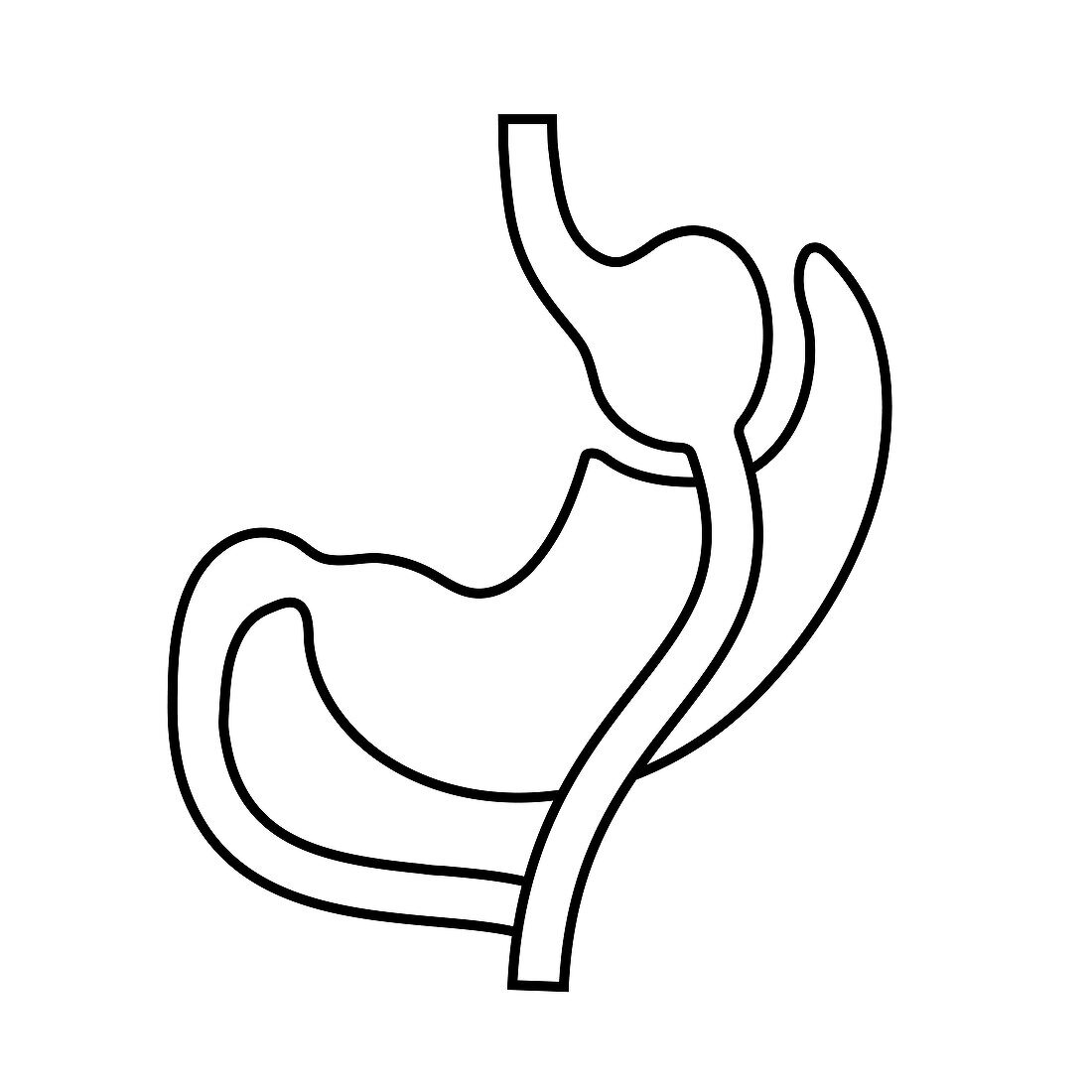 Gastric bypass surgery, illustration