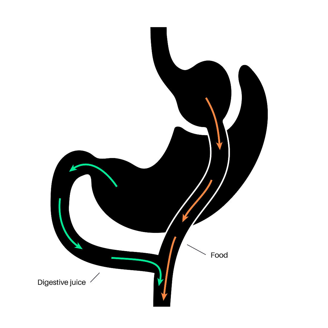 Gastric bypass surgery, illustration