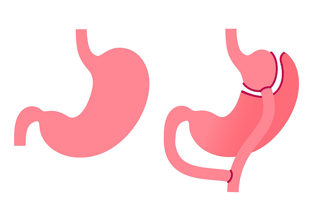 Gastric bypass surgery, illustration