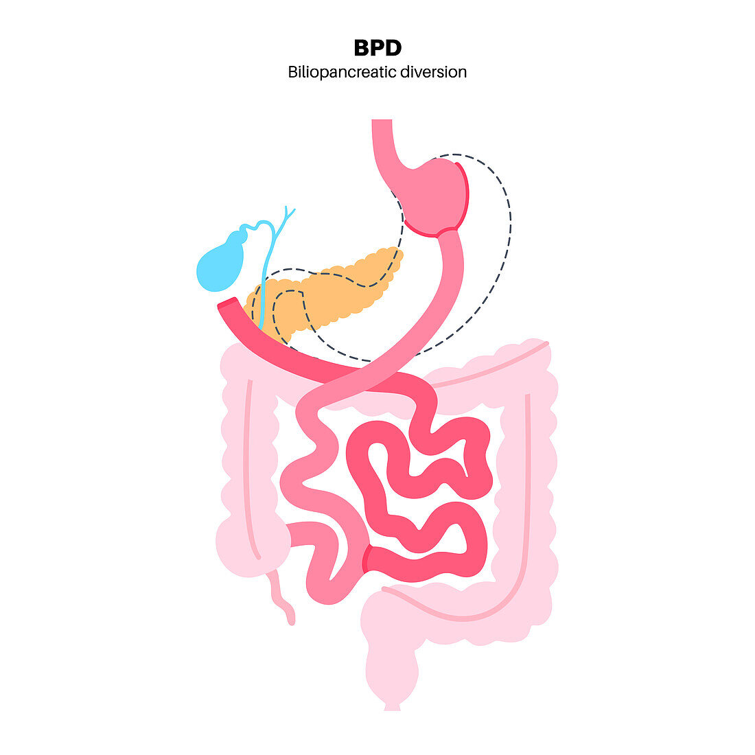 Biliopancreatic diversion procedure, illustration