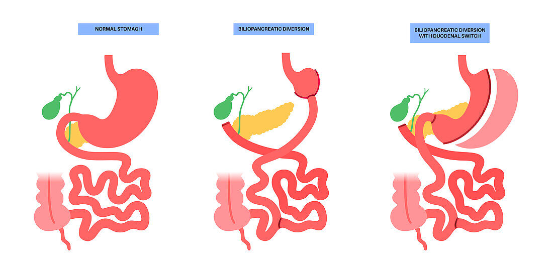 Biliopancreatic diversion procedure, illustration