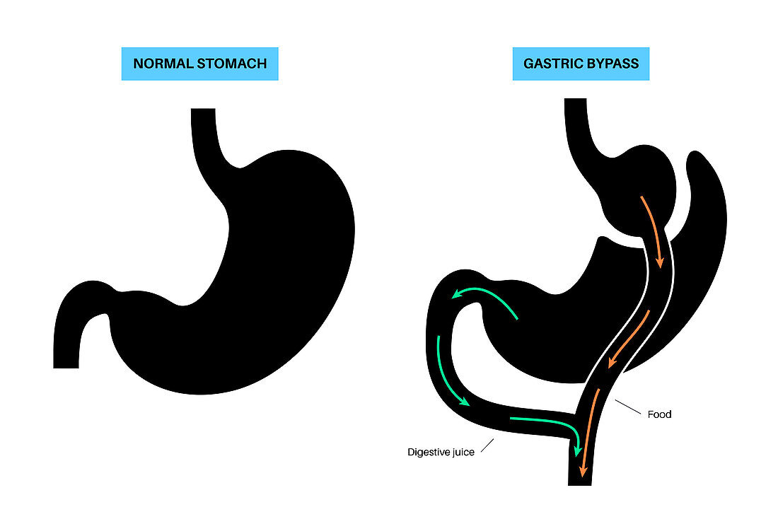 Gastric bypass surgery, illustration