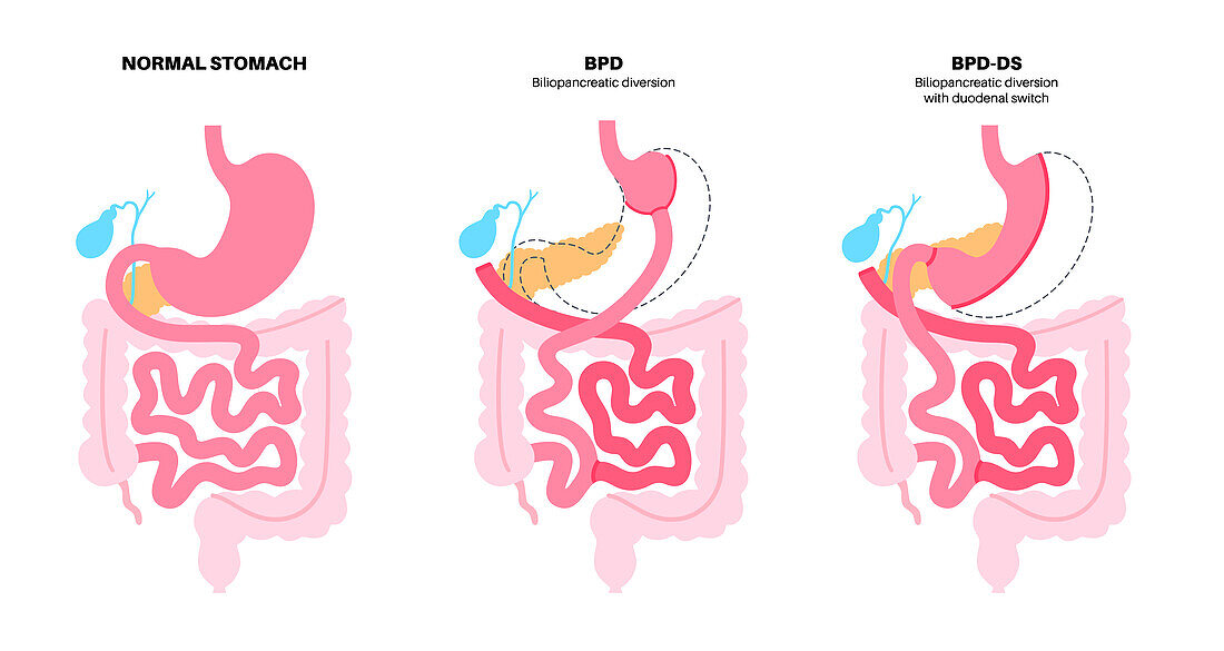 Biliopancreatic diversion procedure, illustration