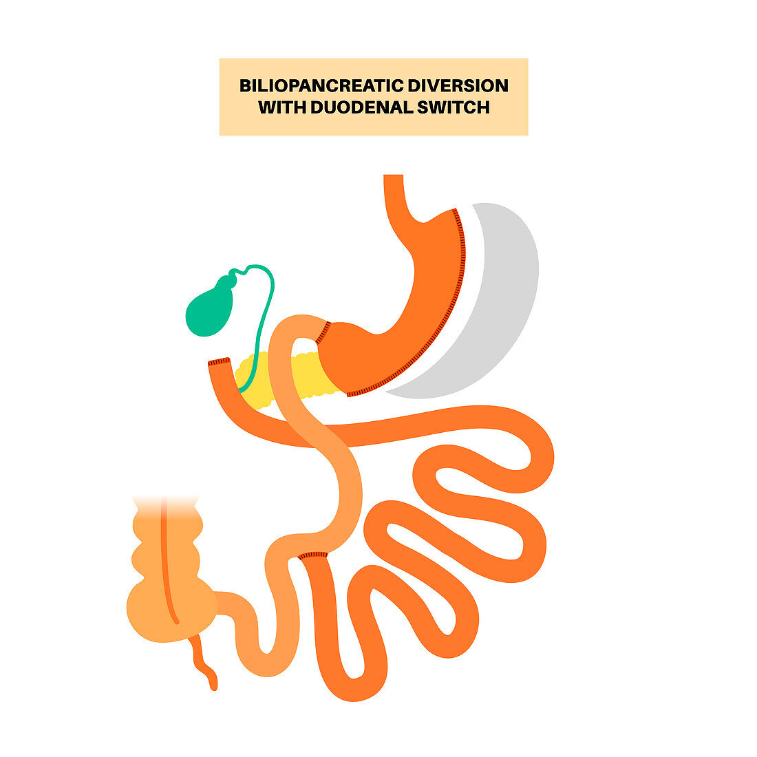 Biliopancreatic diversion procedure, illustration