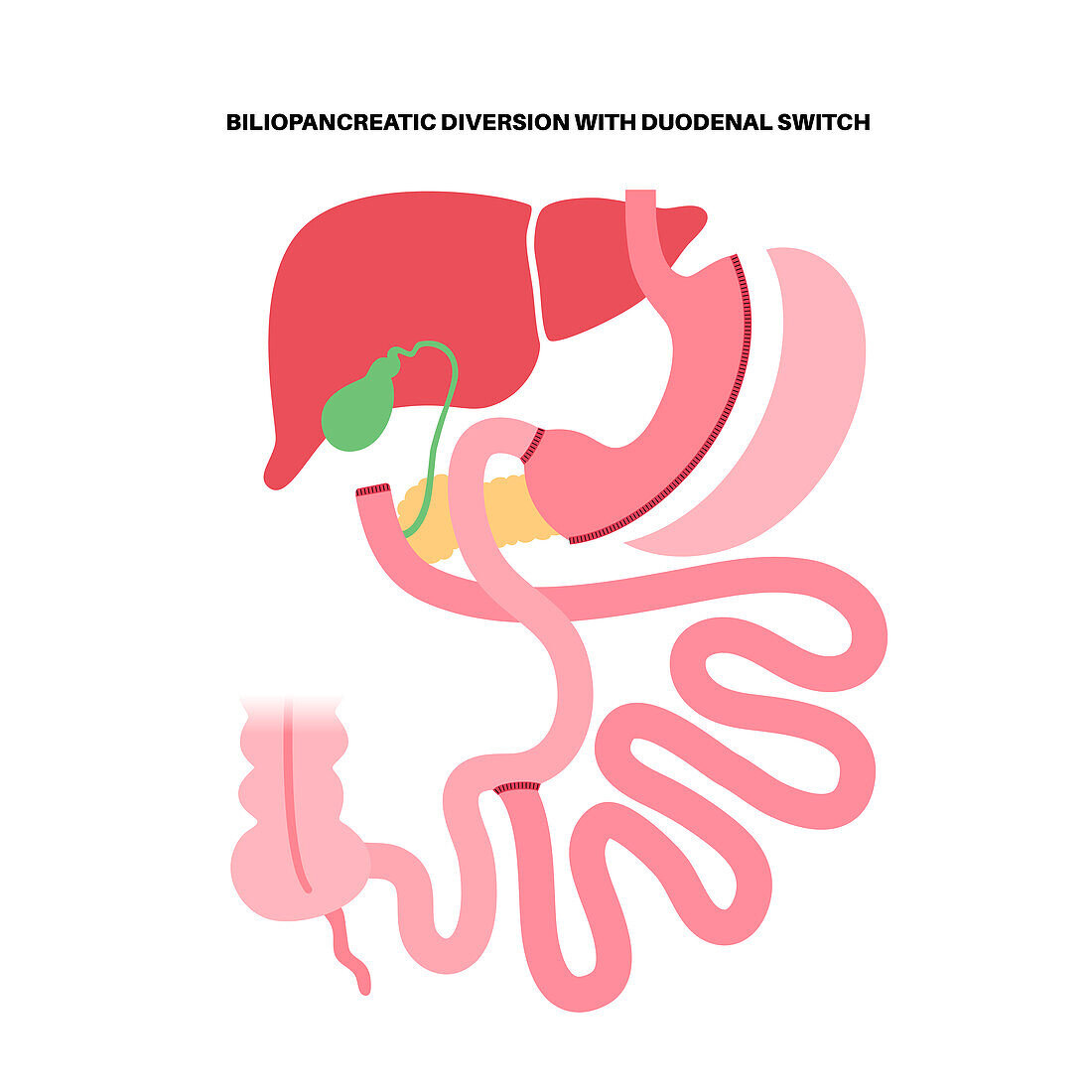 Biliopancreatic diversion procedure, illustration