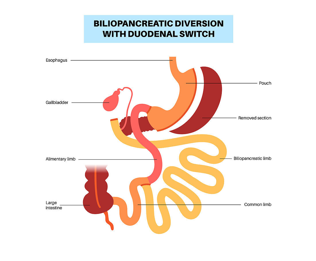 Biliopancreatic diversion procedure, illustration