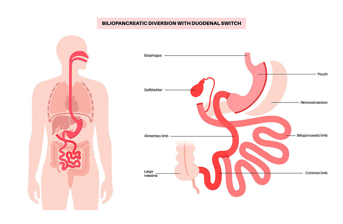 Biliopancreatic diversion procedure, illustration