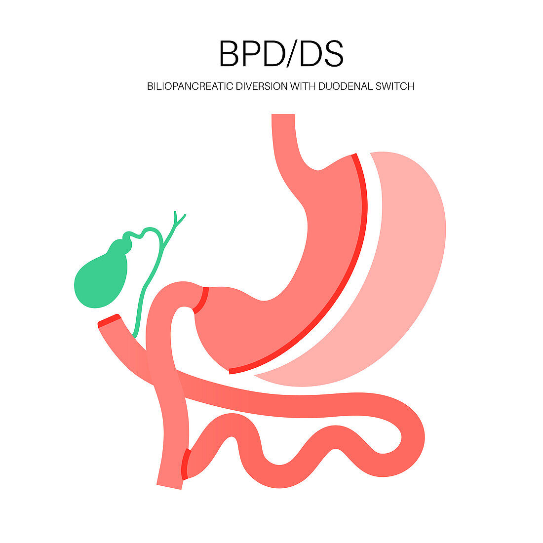 Biliopancreatic diversion procedure, illustration