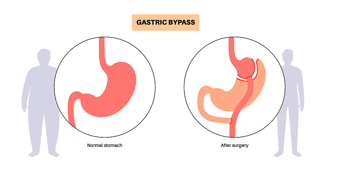 Gastric bypass surgery, illustration