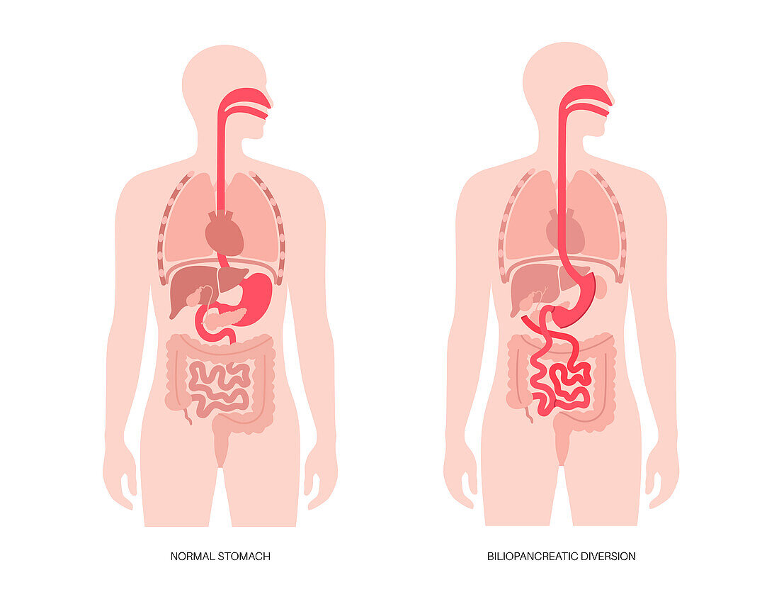 Biliopancreatic diversion procedure, illustration