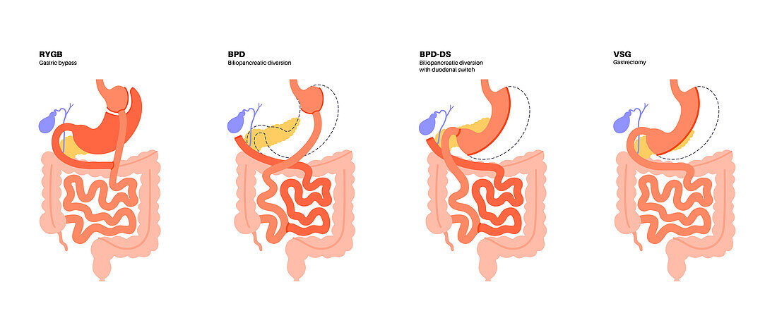 Types of bariatric surgery, illustration