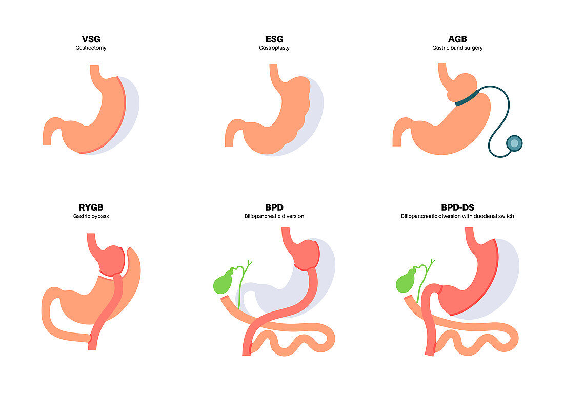 Types of bariatric surgery, illustration