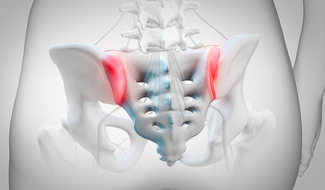 Inflammation of sacroiliac joints, illustration