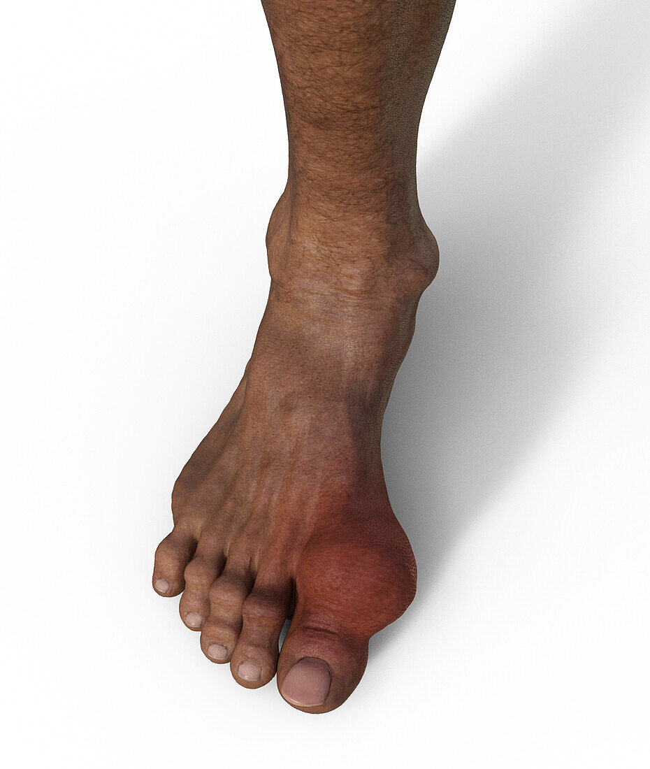Gout-afflicted foot, illustration