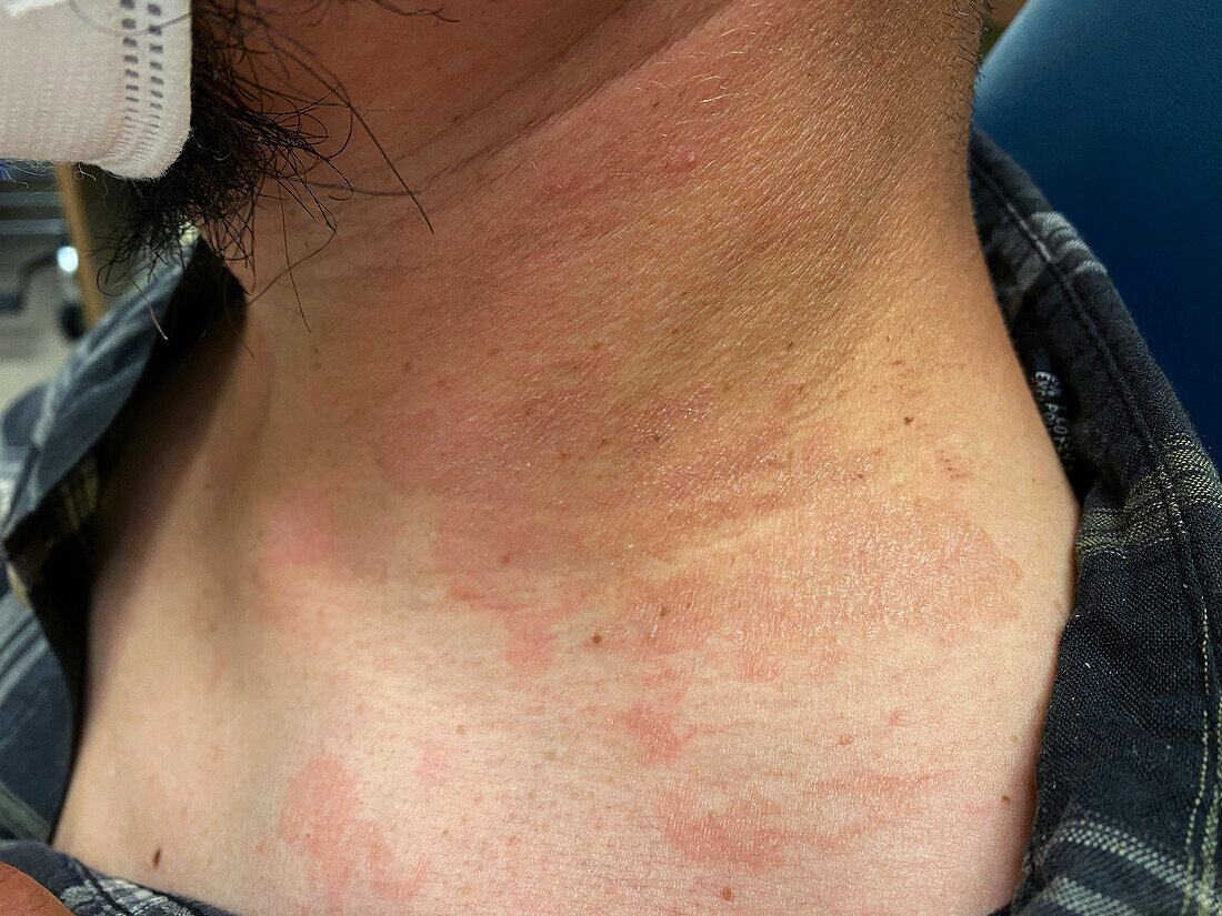 Tinea versicolor