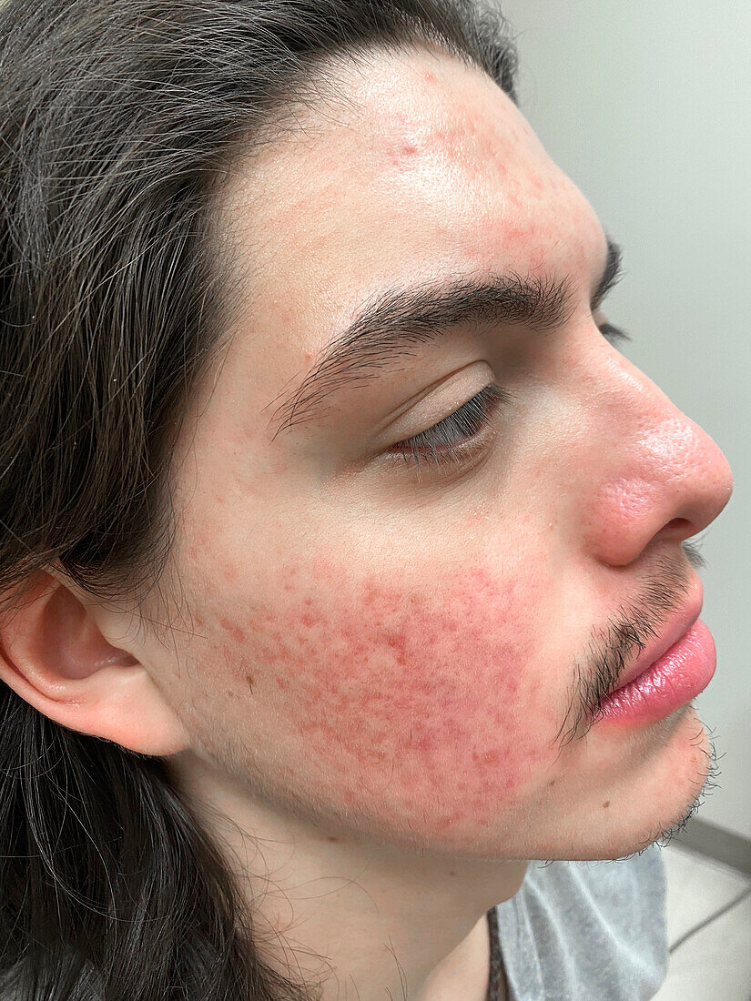 Acne after treatment