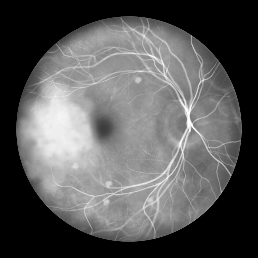 Retina affected by blastomycosis, illustration