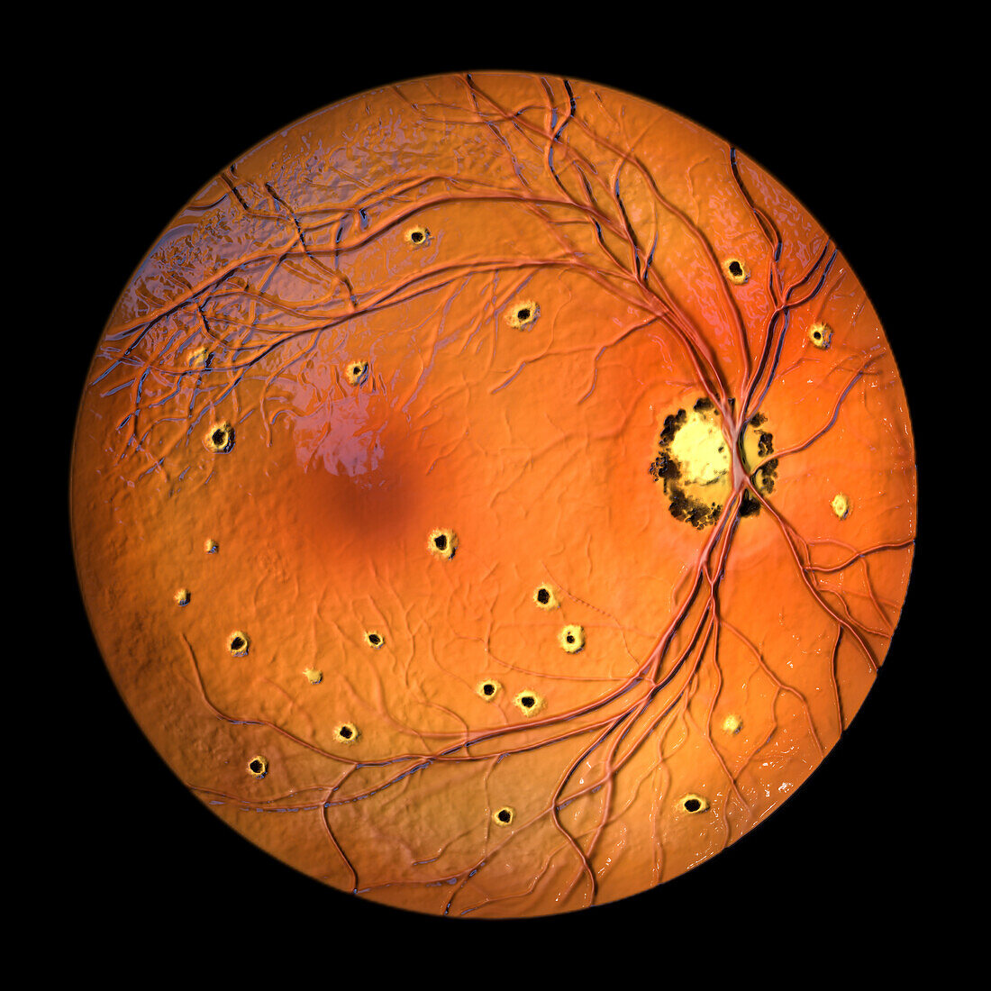 Retina affected by ocular histoplasmosis syndrome, illustration