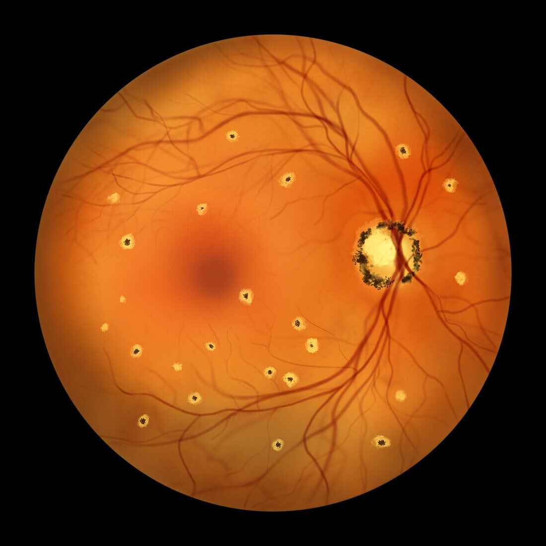 Retina affected by ocular histoplasmosis syndrome, illustration