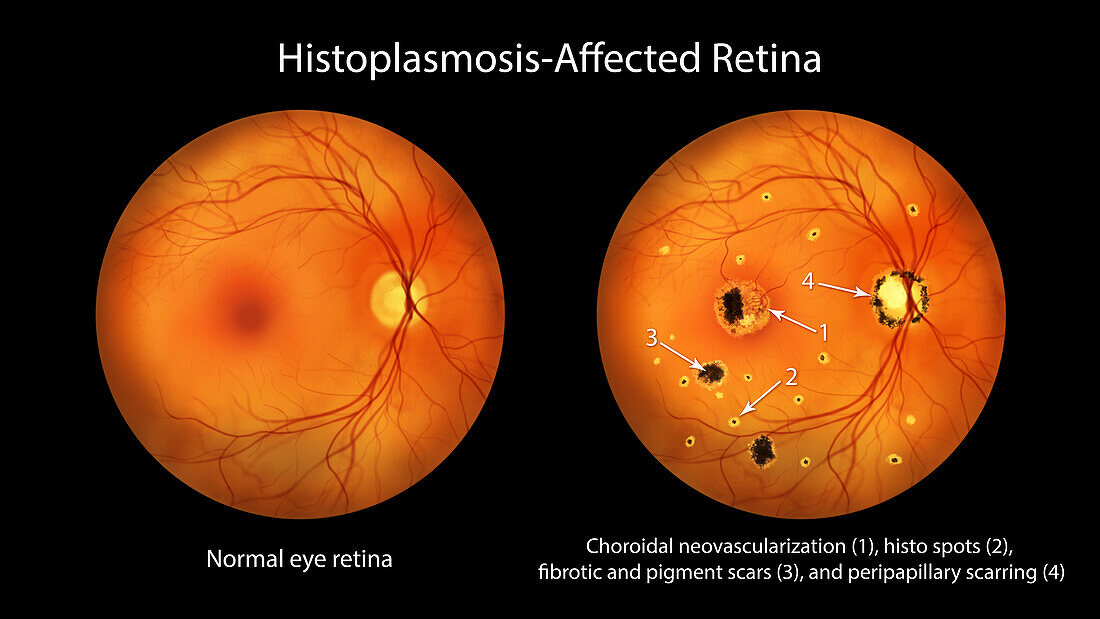 Retina affected by ocular histoplasmosis syndrome, illustration