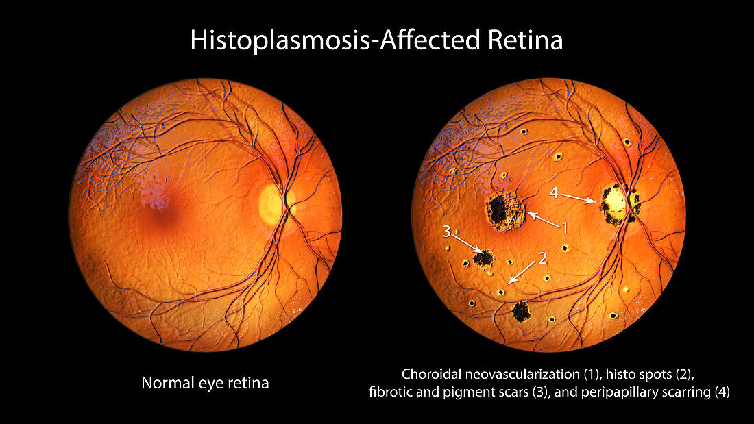 Retina affected by ocular histoplasmosis syndrome, illustration