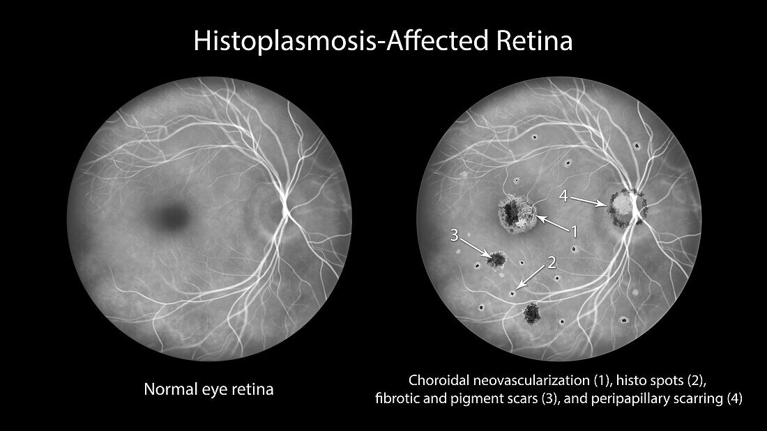 Retina affected by ocular histoplasmosis syndrome, illustration