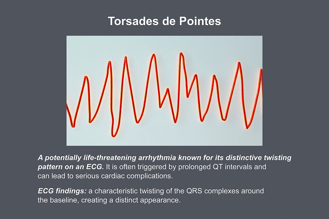 ECG displaying Torsades de pointes rhythm, illustration