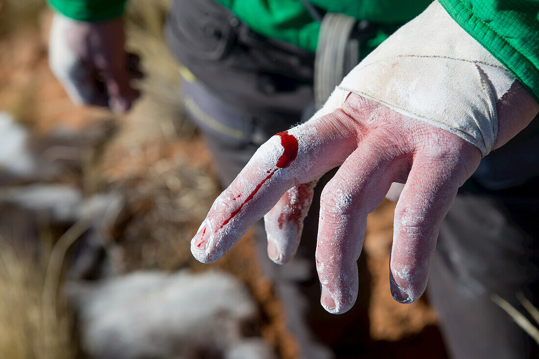 Close up of climber showing injured finger in Colorado.