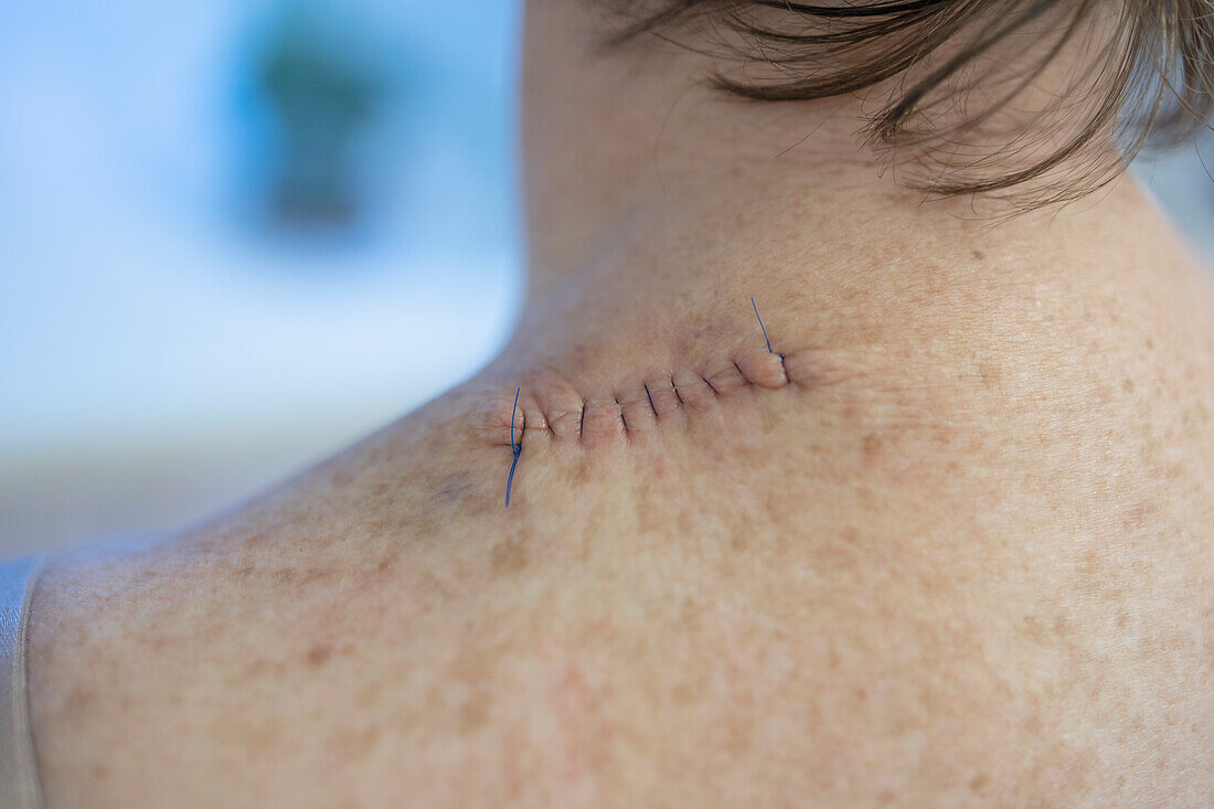 Medizinische Fäden am Rücken einer Frau nach einer Operation