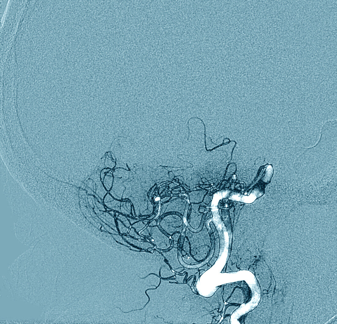 Ischaemic stroke, CT scan