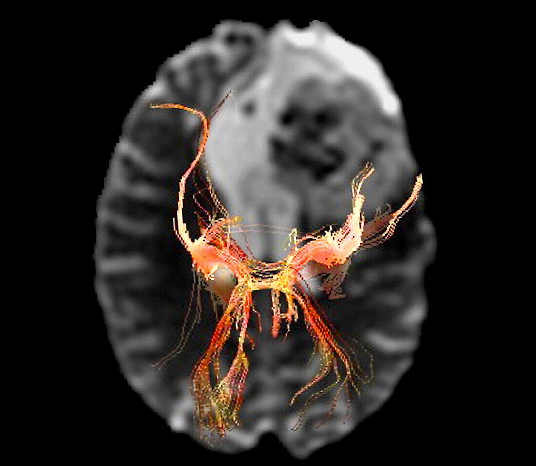 Brain lesion, DTI MRI scan