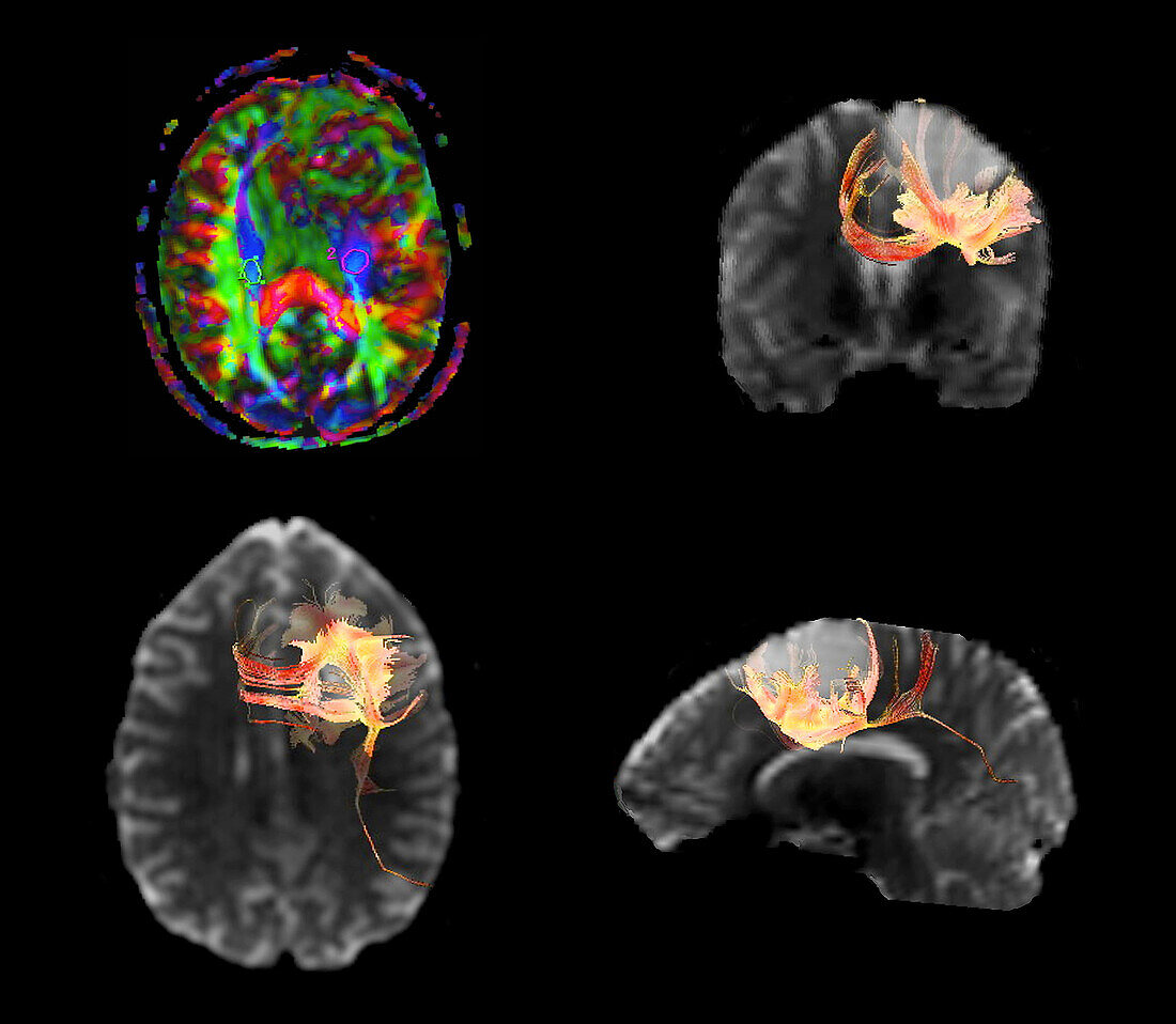 Brain tumour, DTI MRI scans