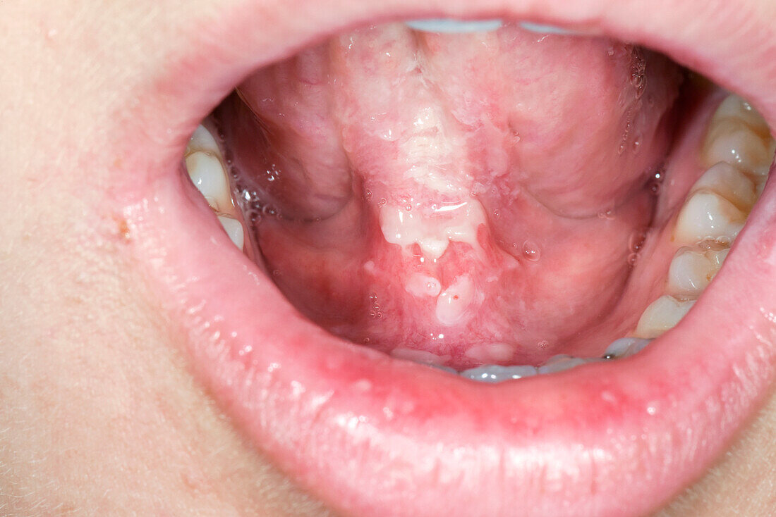 Oral ulcer