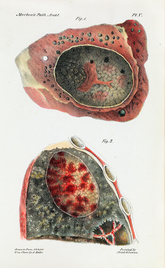 Lungs infected with tuberculosis, 19th century illustration