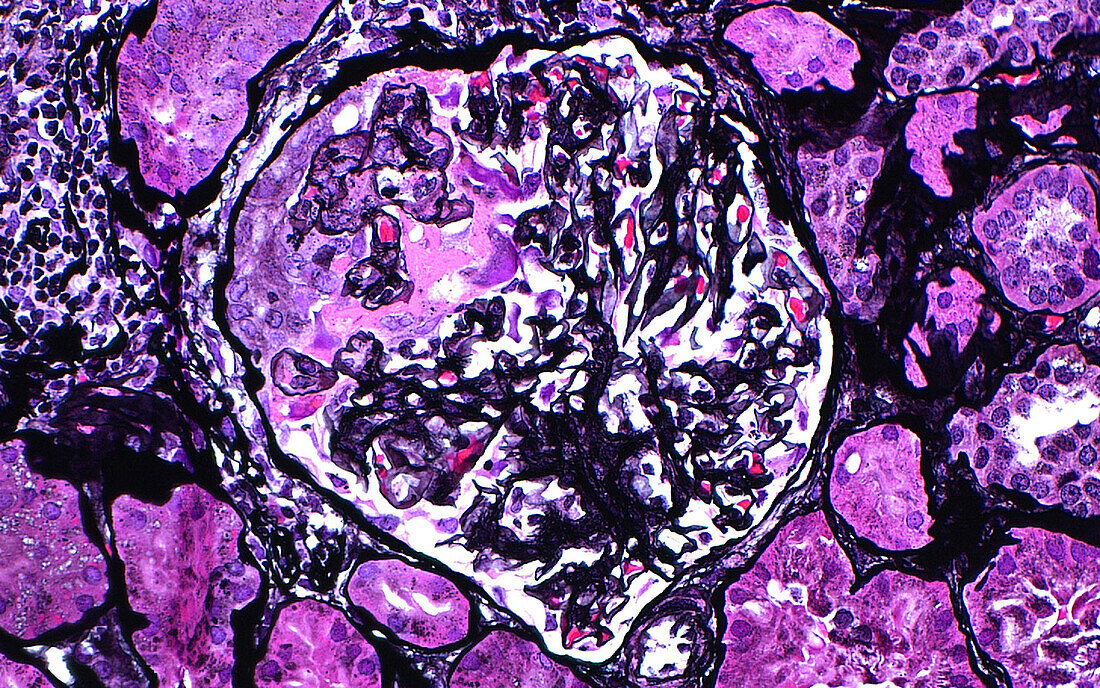 Glomerulus crescent, light micrograph