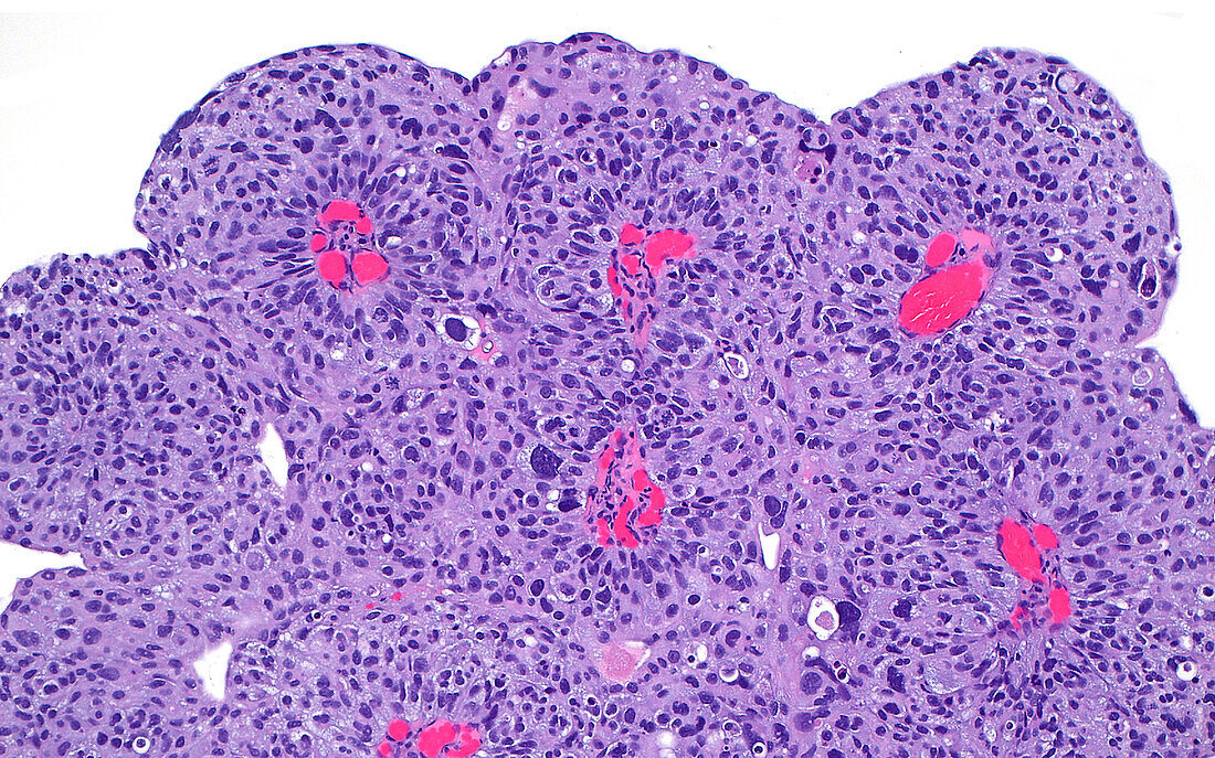 Papillary bladder cancer, light micrograph