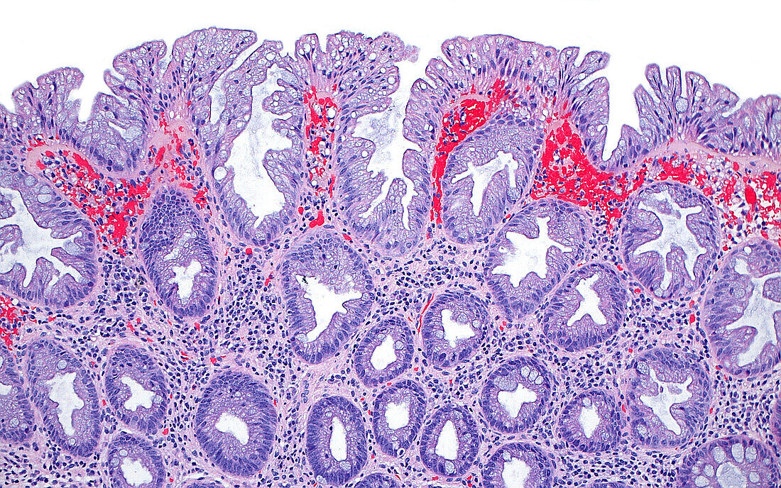 Hyperplastic colon polyp, light micrograph