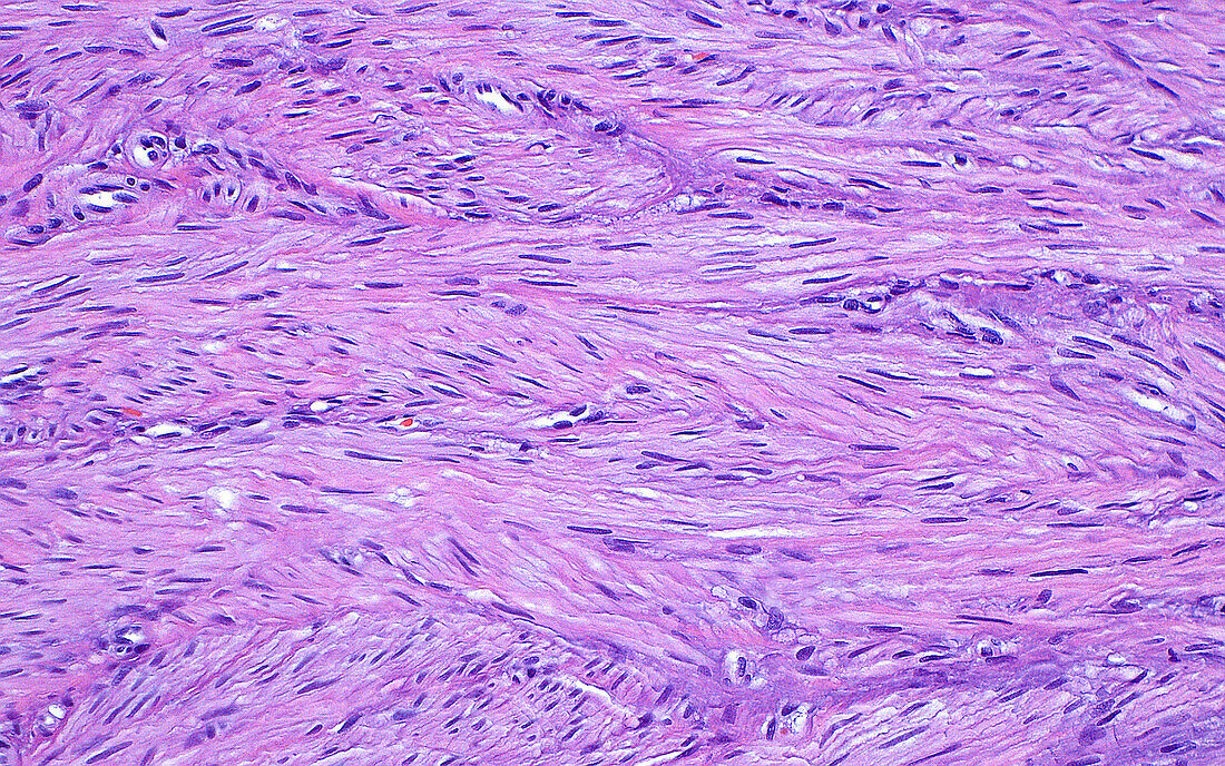 Uterine fibroid, light micrograph