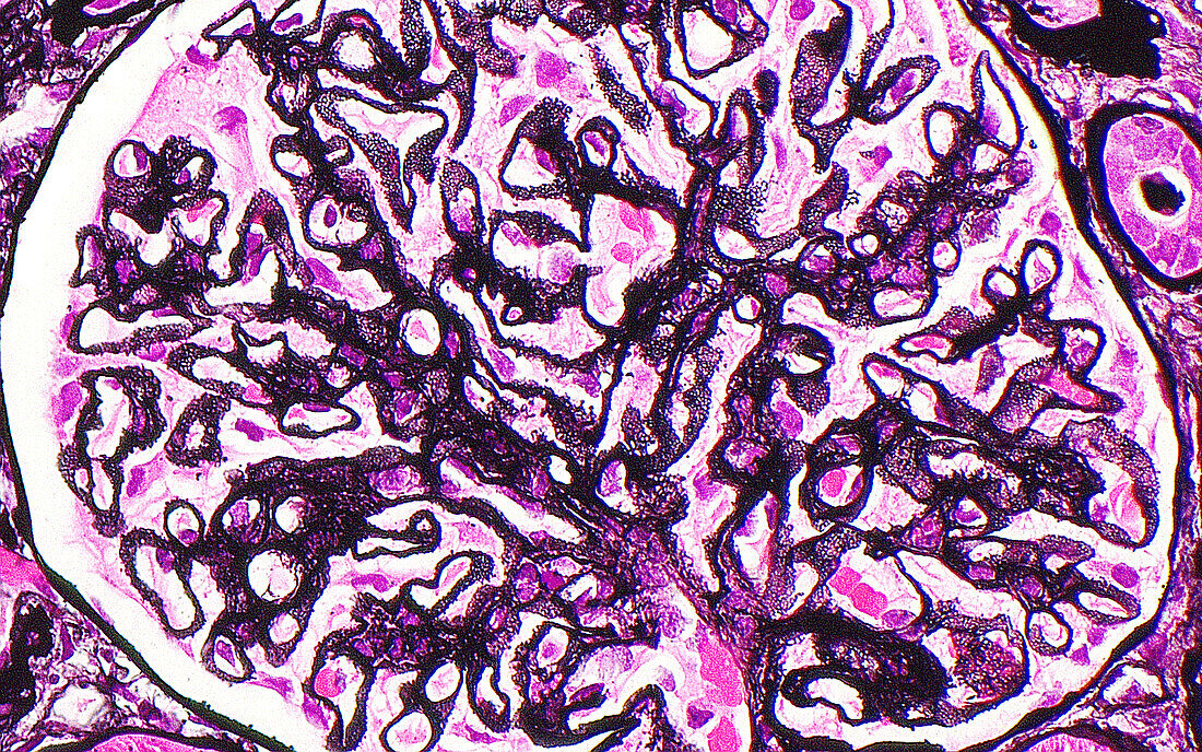 Membranous glomerular disease, light micrograph