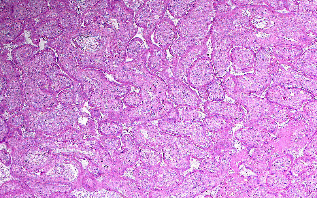Placenta infarct, light micrograph