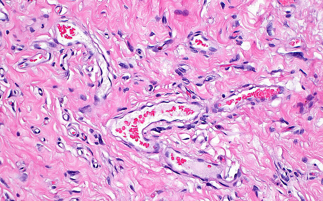 Solitary fibrous tumour vessels, light micrograph