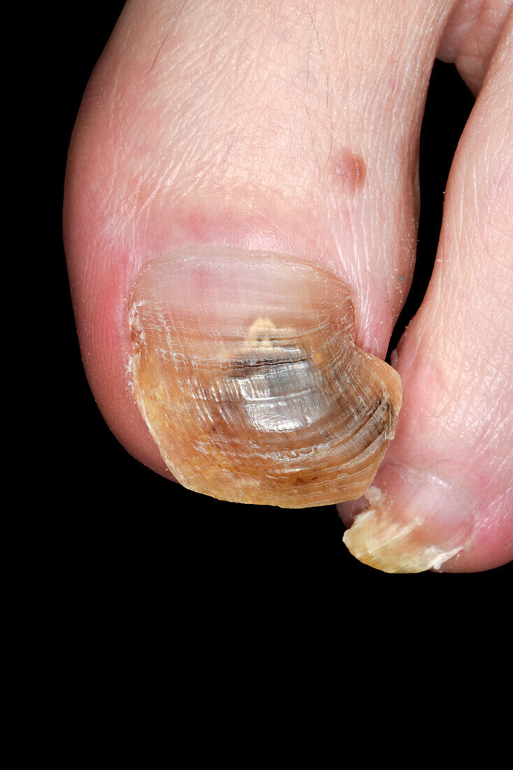 Fungal nail infection