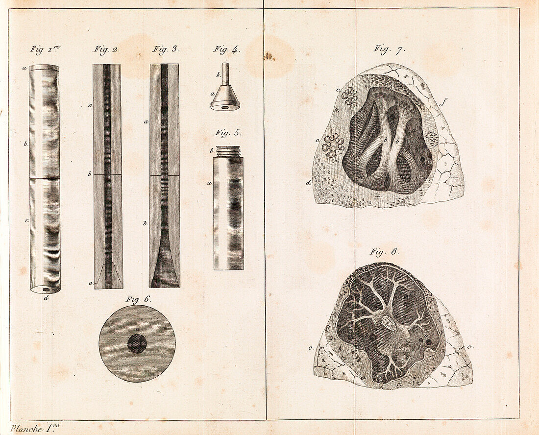 First stethoscope and lungs with tuberculosis, 19th century illustration